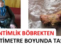 11 SANTİMLİK BÖBREKTEN 7 SANTİMETRE BOYUNDA TAŞ ÇIKTI